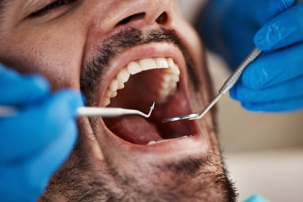 Best Emergency Wisdom Tooth Extraction in Greensburg, IN
