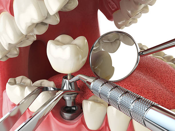 Best Dental Abscess Treatment in Greensburg, IN